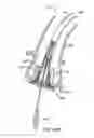 Fig. 56 - Everting heart valve