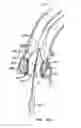 Fig. 57 - Everting heart valve