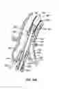 Fig. 59 - Everting heart valve