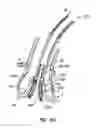 Fig. 61 - Everting heart valve
