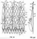 Fig. 02 - LOW PROFILE HEART VALVE AND DELIVERY SYSTEM