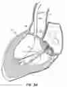 Fig. 08 - LOW PROFILE HEART VALVE AND DELIVERY SYSTEM
