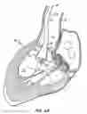 Fig. 09 - LOW PROFILE HEART VALVE AND DELIVERY SYSTEM