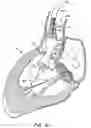 Fig. 10 - LOW PROFILE HEART VALVE AND DELIVERY SYSTEM