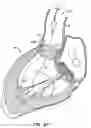 Fig. 13 - LOW PROFILE HEART VALVE AND DELIVERY SYSTEM