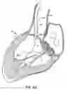 Fig. 14 - LOW PROFILE HEART VALVE AND DELIVERY SYSTEM