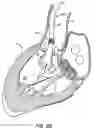 Fig. 15 - LOW PROFILE HEART VALVE AND DELIVERY SYSTEM