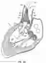 Fig. 16 - LOW PROFILE HEART VALVE AND DELIVERY SYSTEM
