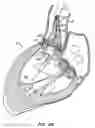 Fig. 17 - LOW PROFILE HEART VALVE AND DELIVERY SYSTEM