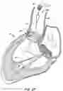 Fig. 19 - LOW PROFILE HEART VALVE AND DELIVERY SYSTEM