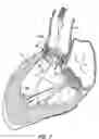 Fig. 20 - LOW PROFILE HEART VALVE AND DELIVERY SYSTEM