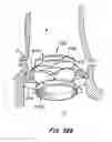 Fig. 49 - LOW PROFILE HEART VALVE AND DELIVERY SYSTEM