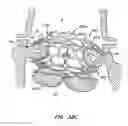 Fig. 50 - LOW PROFILE HEART VALVE AND DELIVERY SYSTEM