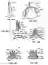 Fig. 52 - LOW PROFILE HEART VALVE AND DELIVERY SYSTEM