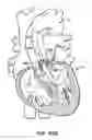 Fig. 55 - LOW PROFILE HEART VALVE AND DELIVERY SYSTEM