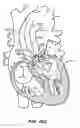 Fig. 56 - LOW PROFILE HEART VALVE AND DELIVERY SYSTEM