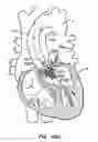 Fig. 57 - LOW PROFILE HEART VALVE AND DELIVERY SYSTEM