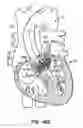 Fig. 58 - LOW PROFILE HEART VALVE AND DELIVERY SYSTEM