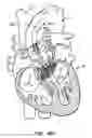 Fig. 59 - LOW PROFILE HEART VALVE AND DELIVERY SYSTEM