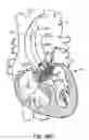Fig. 60 - LOW PROFILE HEART VALVE AND DELIVERY SYSTEM