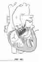 Fig. 62 - LOW PROFILE HEART VALVE AND DELIVERY SYSTEM