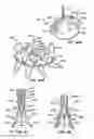 Fig. 63 - LOW PROFILE HEART VALVE AND DELIVERY SYSTEM