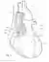 Fig. 03 - Sizing methods for a valved conduit graft
