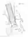 Fig. 10 - Sizing methods for a valved conduit graft