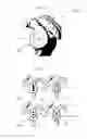 Fig. 02 - Prosthetic glenoid component