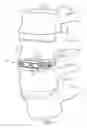 Fig. 02 - Implant with deployable blades