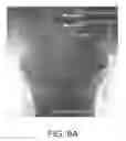 Fig. 09 - Implant placement