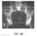 Fig. 10 - Implant placement