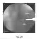 Fig. 24 - Implant placement