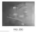 Fig. 27 - Implant placement