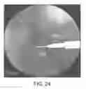 Fig. 29 - Implant placement