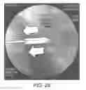 Fig. 33 - Implant placement