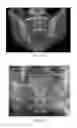 Fig. 40 - Implant placement