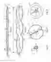 Fig. 03 - Deploying a balloon expandable stent to induce spiral flow