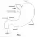 Fig. 02 - GASTRO-ESOPHAGEAL IMPLANTS
