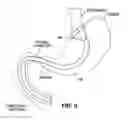Fig. 08 - GASTRO-ESOPHAGEAL IMPLANTS