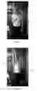 Fig. 03 - Arm immobilization apparatus and methods for wearing the apparatus