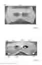 Fig. 45 - THERMAL EYE COMPRESS SYSTEMS AND METHODS OF USE