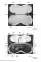 Fig. 47 - THERMAL EYE COMPRESS SYSTEMS AND METHODS OF USE