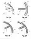 Fig. 02 - Shunt device and method for treating ocular disorders