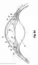 Fig. 06 - Shunt device and method for treating ocular disorders