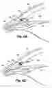 Fig. 07 - Shunt device and method for treating ocular disorders