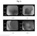 Fig. 04 - Bowel cleansing composition