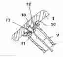 Fig. 01 - Implantable blood conveying device, manipulating device and coupling device