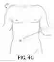Fig. 08 - METHOD FOR PERITONEAL REMOVAL OF ELECTROLYTES AND INFLAMMATORY MEDIATORS