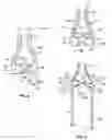 Fig. 04 - Dental syringe with stabilizer for removable needle
